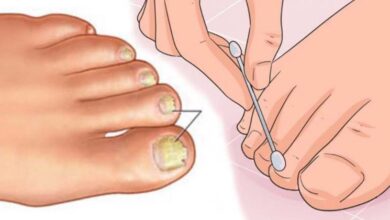 Say Goodbye to Fungal Nails with This Simple Homemade Remedy!